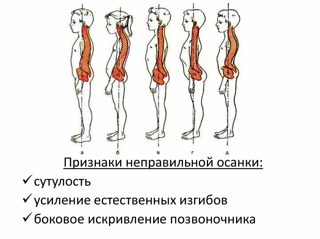 Круглая спина упражнения. Дефекты осанки. Нормальная осанка. Круглая плоская спина. Плоская спина и нормальная.