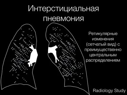 Интерстициальная пневмония