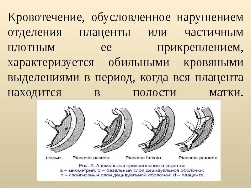 Истинное приращение. Полное плотное прикрепление плаценты классификация. Аномалии прикрепления плаценты. Патологическое прикрепление плаценты. Прикрепление и приращение плаценты классификация.