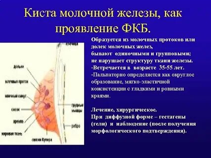 Киста грудины у женщин опасно