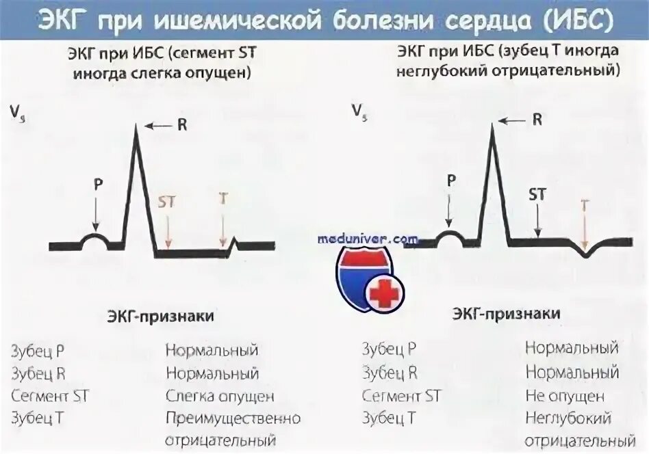 Ишемический подъем st. Ишемический подъем st