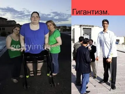 Гигантизм сахарный диабет