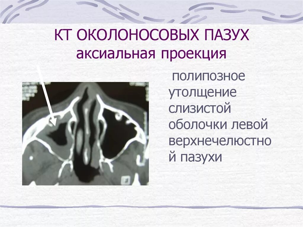 Синусит верхнечелюстной пазухи. Полип гайморовой пазухи на кт. Пристеночный гиперпластический верхнечелюстной синусит. Хронический синусит кт. Локальное утолщение слизистой