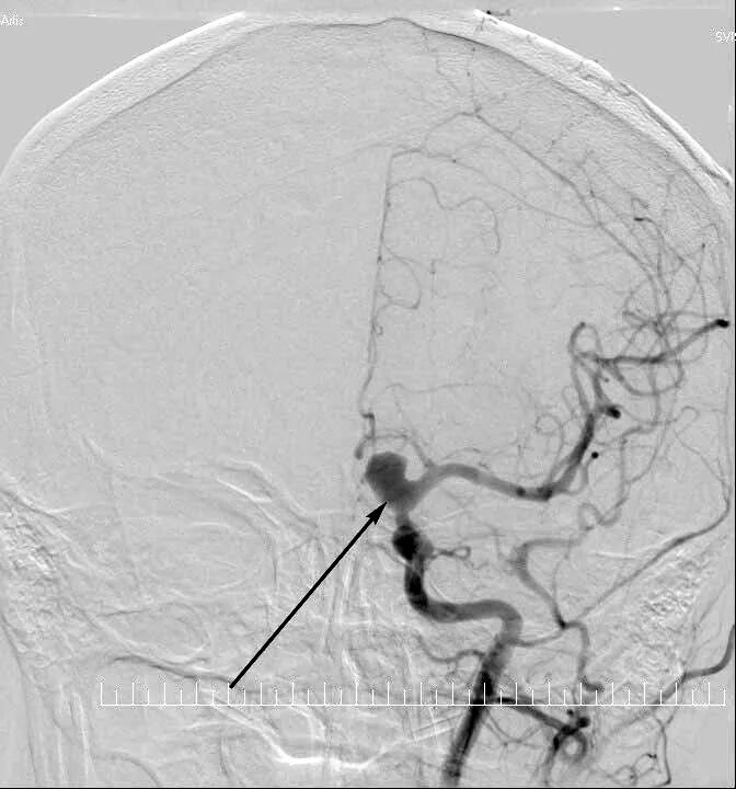 Форум аневризма мозга. Аневризма сосудов головного мозга кт. Аневризма артерии головного мозга. Ангиография аневризма. Аневризма артерии головного мозга симптомы.