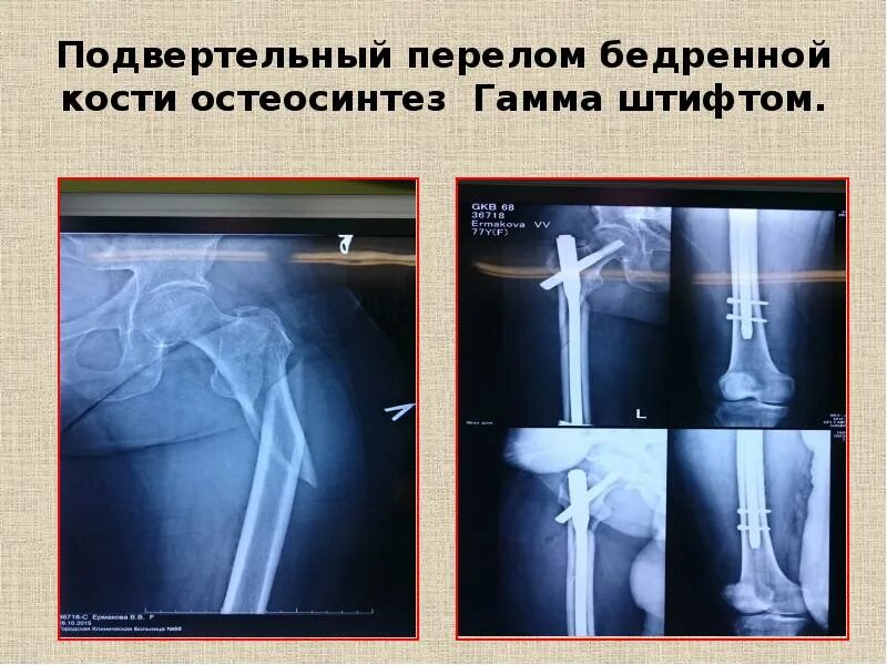 Подвертельный перелом бедренной кости рентген. Интрамедуллярный остеосинтез биос. Блокируемый интрамедуллярный остеосинтез гамма. Перелом шейки бедра остеосинтез рентген.