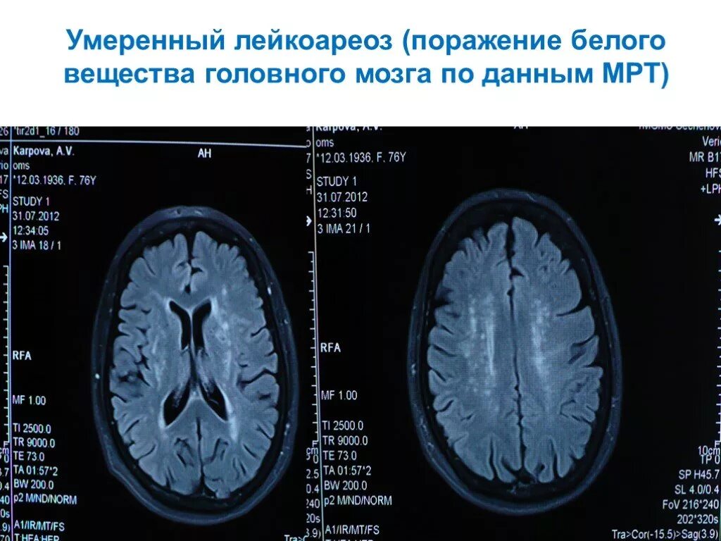 Перивентрикулярный лейкоареоз на кт. Кт признаки лейкоареоза головного мозга. Лейкоареоз на кт. Очаги лейкоареоза на мрт. Поражение белого вещества мозга