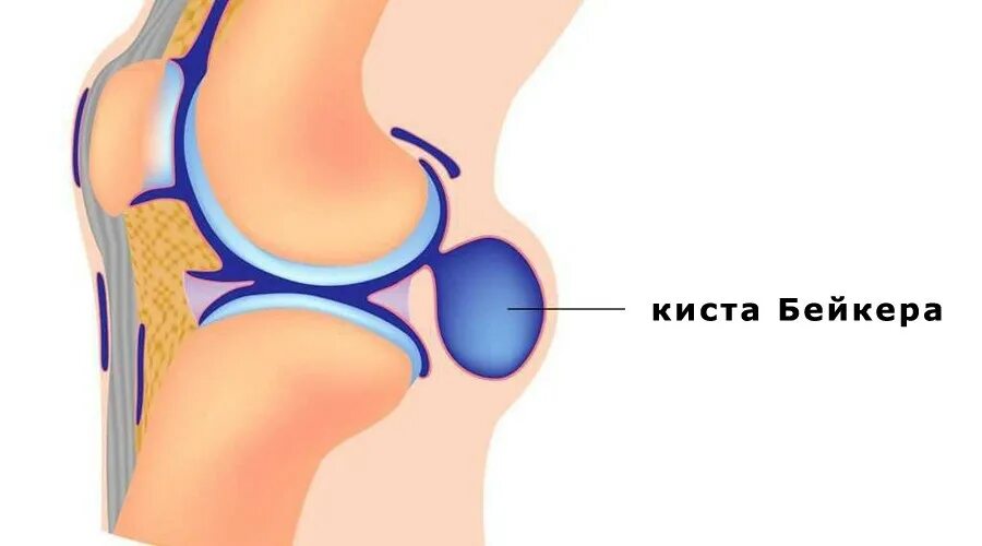 узи подколенной области. синовиальная киста мкб. обызвествленная киста бейкера. синовиальная киста мкб. синовиальная киста мкб.
