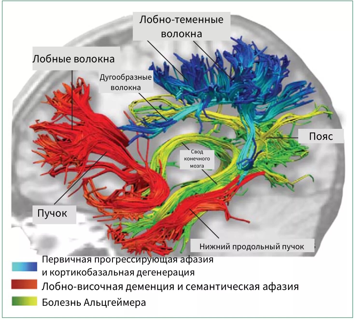 лобно-височная деменция мрт. болезнь альцгеймера локализация поражения. лобно-височная деменция мрт. лобовисочнуя деменция. височная дегенерация.