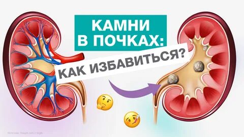 КАК избавиться от КАМНЕЙ В ПОЧКАХ? - смотреть видео онлайн от "МЕДСИ" в хорошем 