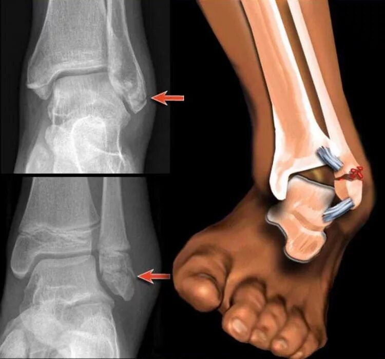 Супинационно-аддукционный перелом лодыжки. Голеностопный сустав перелом малоберцовой кости. Перелом наружной лодыжки малоберцовой кости. Перелом наружной лодыжки большеберцовой кости. Болят кости после операции