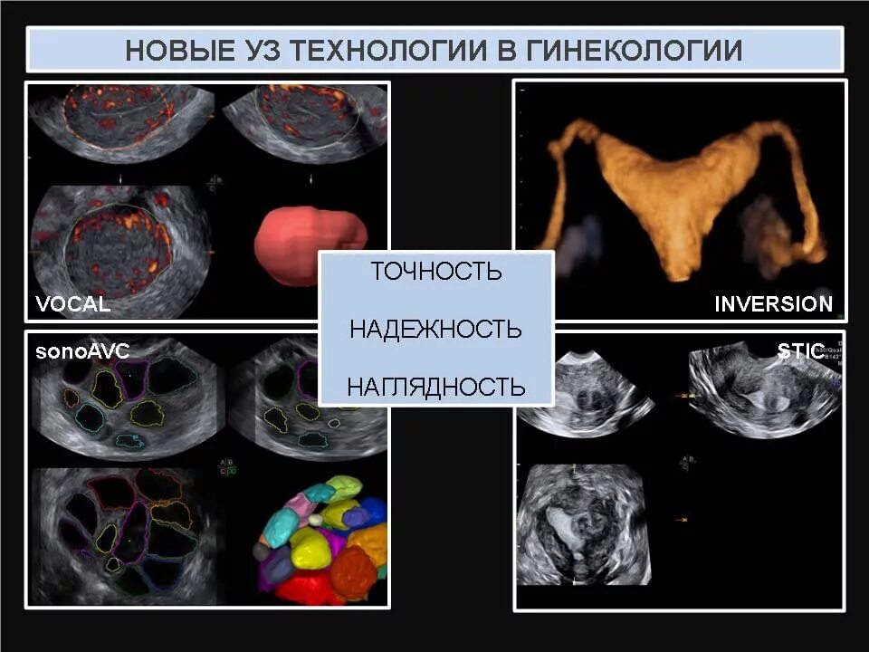 Мультифолликулярный поликистоз яичников. Критерии мультифолликулярных яичников УЗИ. Мультифолликулярная структура яичников по УЗИ. Мультифолликулярная трансформация яичников. Мфя в гинекологии что