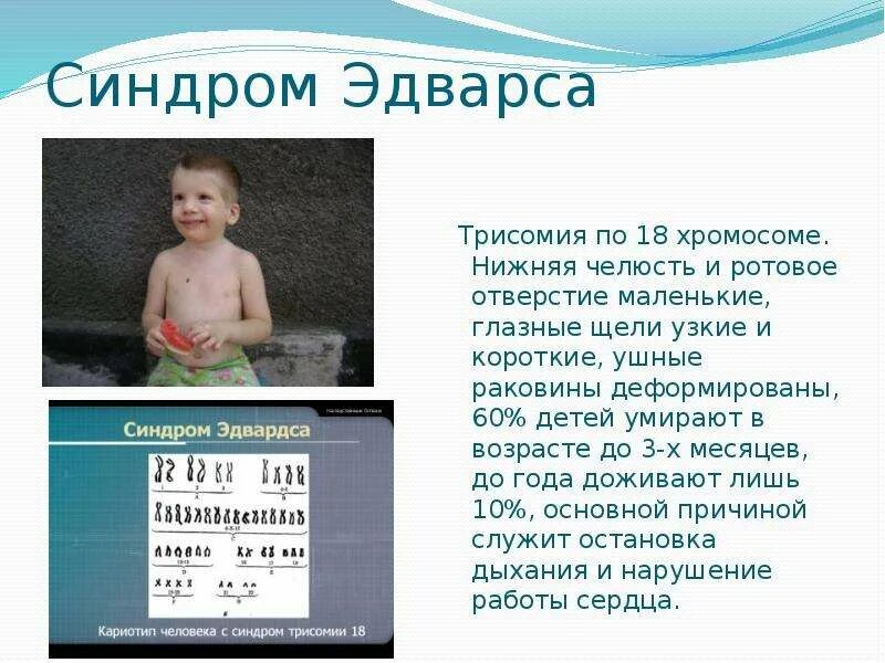 Синдром трипло. Трисомия по 18 хромосоме синдром Эдвардса. Мозаичная трисомия по 18 хромосоме. Трисомия по 18 хромосоме синдром. Синдром трисомии х хромосомы.