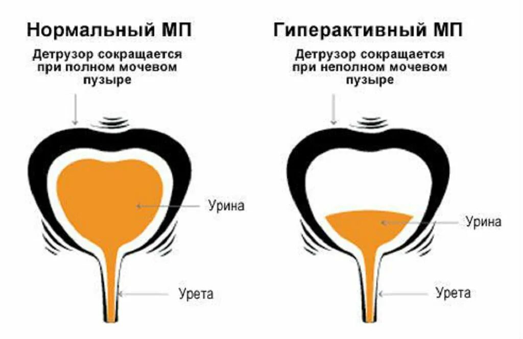 Гипоактивный мочевой пузырь. Нейрогенный гиперактивный мочевой пузырь. Детрузора мочевого пузыря. Мочевой пузырь гиперактивный мочевой пузырь. Нервы мочеиспускание