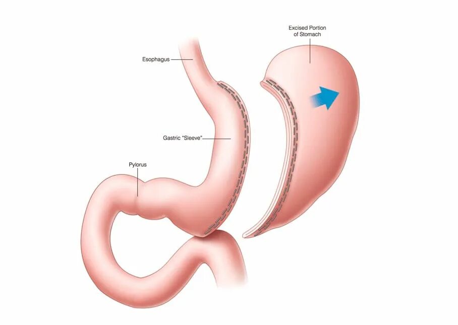 Продольная резекция желудка _Sleeve Gastrectomy. Бариатрическая операция продольная резекция желудка.