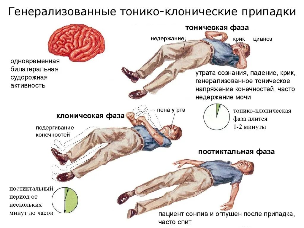 Эпилепсия что это у взрослых