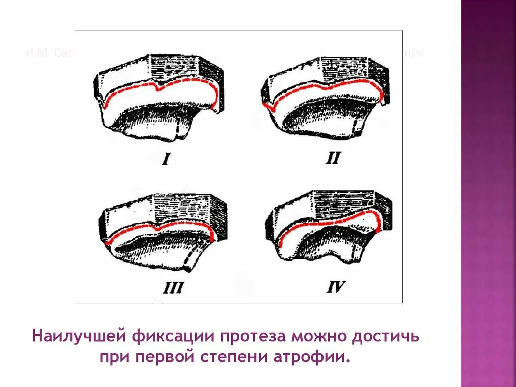 Оксман классификация беззубых. Классификация беззубых челюстей по Оксману. Атрофия альвеолярного отростка классификация по Оксману. Суппле классификация слизистой оболочки. Люнд слизистой оболочки