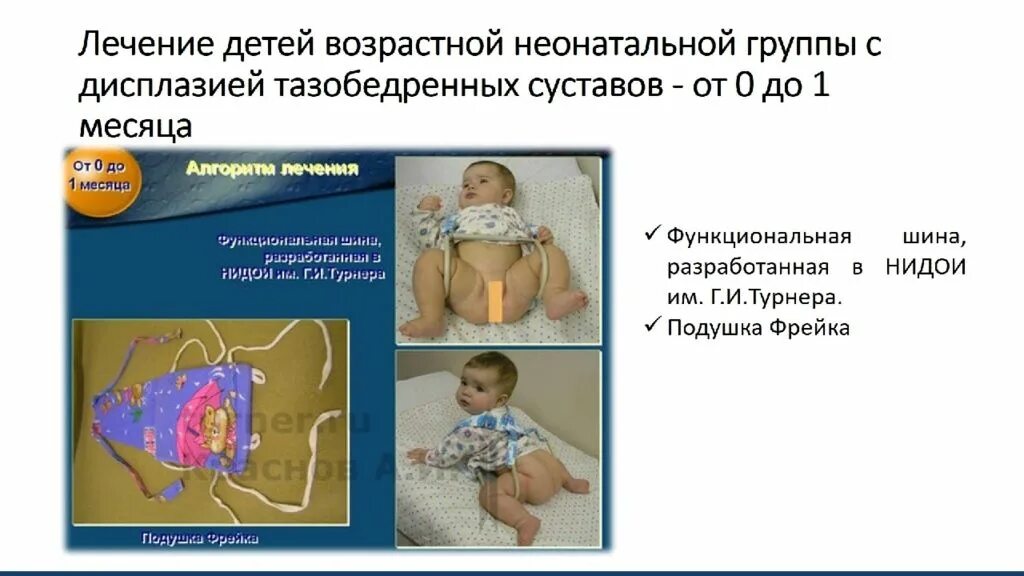Наличия дисплазии. Гипсование дисплазия тазобедренного. Дисплазия тазобедренных суставов у новорожденных шина. Врожденный вывих тазобедренного сустава. Дисплазия тазобедренных суставов шина.