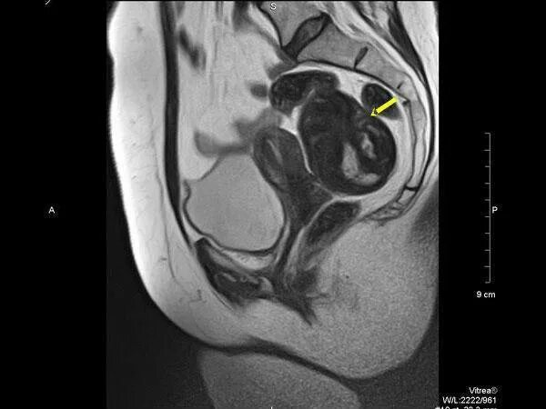 Кт малого таза у женщин с контрастированием. Мрт органов малого таза норма. Сибирский тракт 34 к5 мрт. Мрт омт с контрастированием органов малого таза. Кт малого таза с контрастированием.