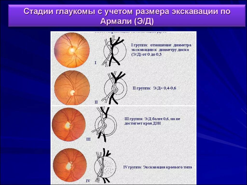 Зрительный нерв при глаукоме. Краевая экскавация диска зрительного нерва. Экскавация диска зрительного нерва норма. Физиологическая экскавация зрительного нерва.