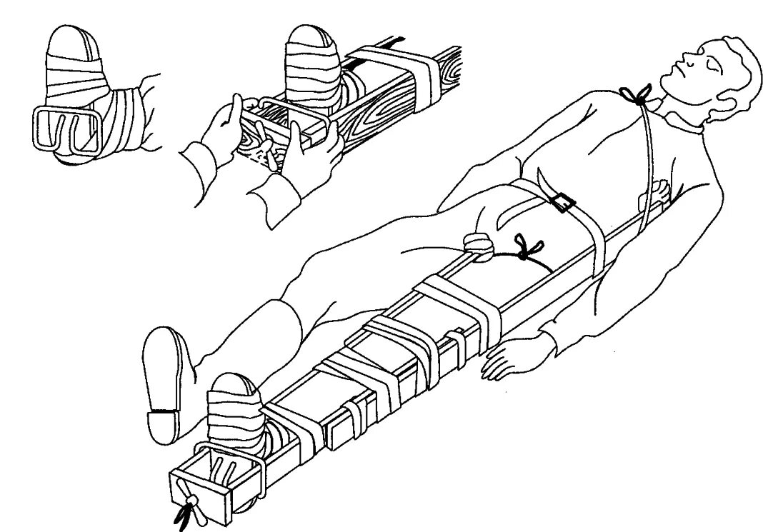 Перелом голени транспортировка. Иммобилизация шиной Дитерихса. Шина Дитерихса при переломе бедра. Транспортная иммобилизация перелома бедра шиной Дитерихса. Транспортная иммобилизация при переломе бедренной кости.