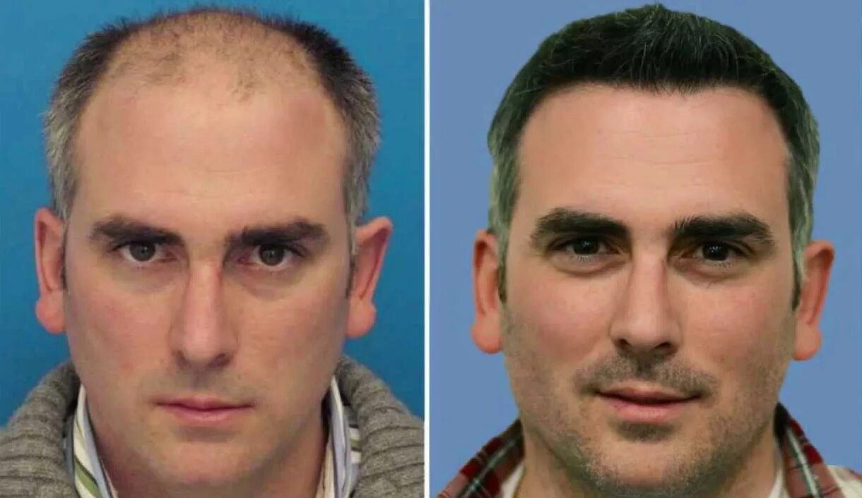 Решал лицо. До и после пересадки волос. Пересадка волос до и после. Трансплантация волос до и после. До и после пересадки волос мужчинам.