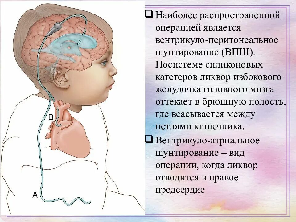 Шунт при гидроцефалии