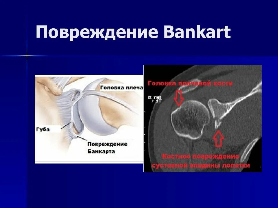 Плечевая губа суставная разрыв. Повреждение Банкарта плечевого. Повреждение Банкарта и Хилл-Сакса плечевого сустава. Повреждение Банкарта на кт. Перелом Хилл-Сакса плечевой.