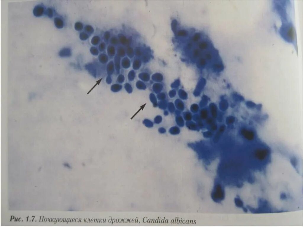 Споры candida. Почкующиеся дрожжевые клетки микроскопия. Споры грибов кандида. Почкующиеся дрожжевые клетки в мазке на флору. Candida albicans почкующиеся клетки.