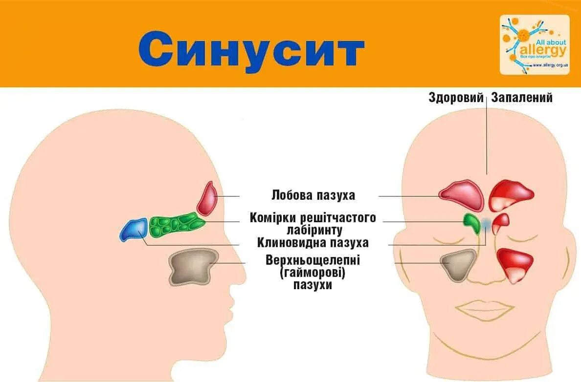 Гнойный насморк у взрослых. Синуси.