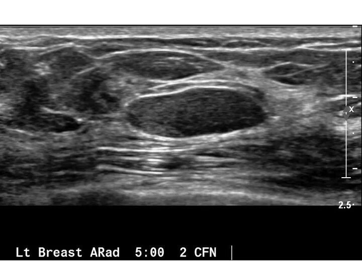 Фиброаденома снимок УЗИ. Фиброаденома молочной железы УЗИ картина.