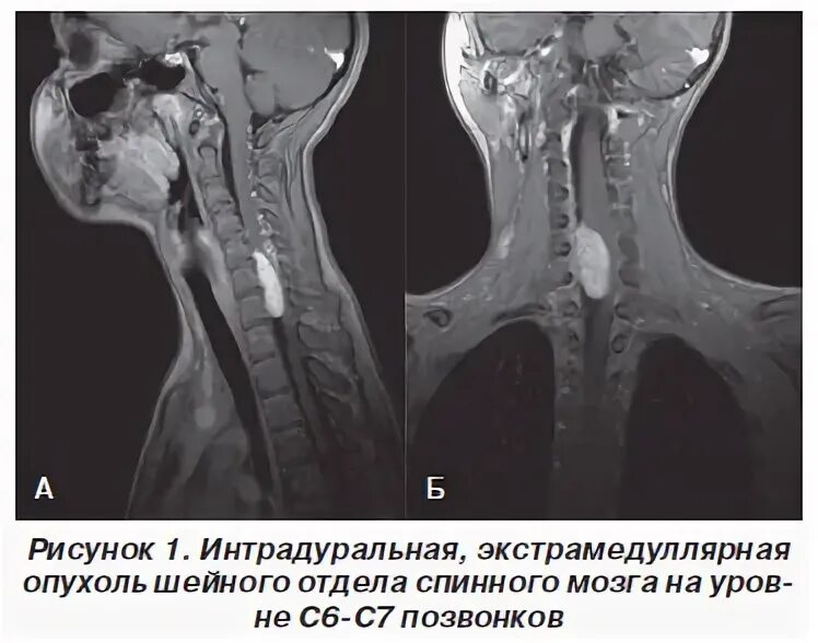 Доброкачественная опухоль позвоночника. Опухоль шейного отдела позвоночника симптомы. Шейный отдел позвоночника c5-c6. Интрамедуллярная опухоль спинного мозга мрт. Образования в шейном отделе.