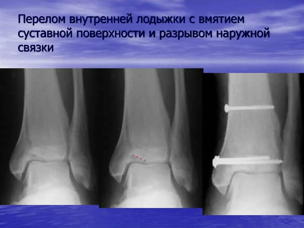 Лодыжки перелом перелом лодыжки. Перелом наружной лодыжки рентген. Внутрисуставные переломы голеностопного сустава рентген. Перелом метафиза наружной лодыжки.