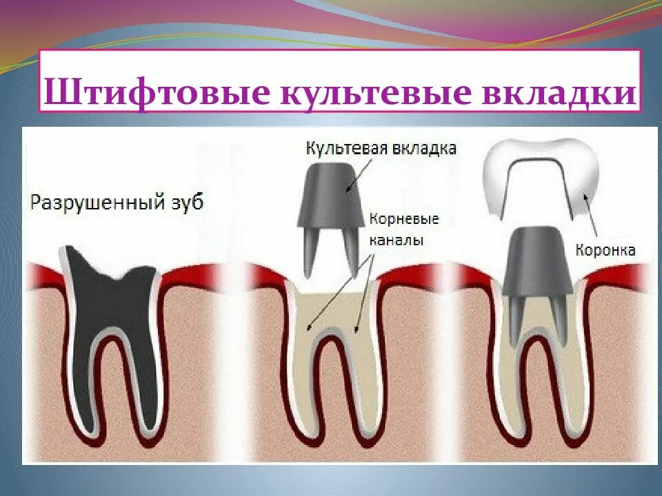 Культевая вкладка штифт зуб. Культевые вкладки и коронки. Вкладки в корень зуба металлическая.