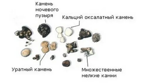 Вышел камень при мочеиспускании