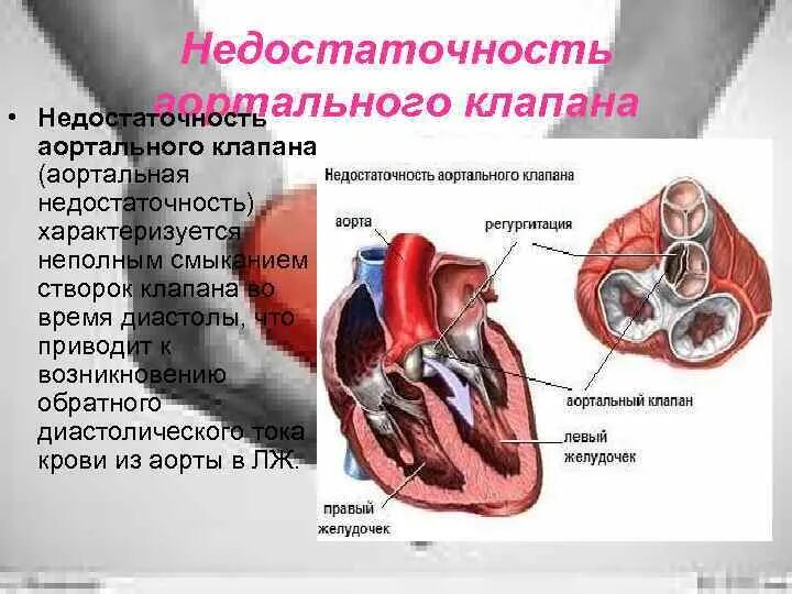 Дегенерация митрального клапана. Стеноз и недостаточность аортального клапана. Уплотненные створки аортального клапана. ВПС двустворчатый аортальный клапан. Недостаточность аортального клапана 1-2.