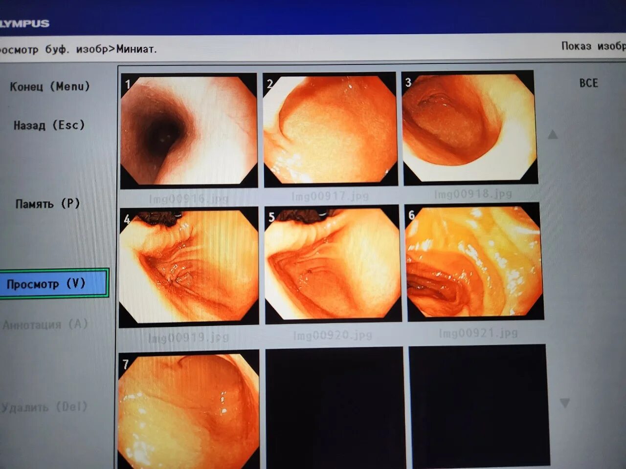 Гастрит дуоденит гастродуоденит. Хронический гастрит и гастродуоденит у детей. Терапия хронического гастродуоденита. Лекарства при хроническом гастродуодените. Симптомы хронического гастродуоденита у детей.