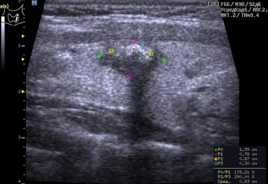 Щитовидная железа узи лимфоузлы. Гиперэхогенный узел в щитовидной железе УЗИ. Кальцинат щитовидной железы УЗИ. УЗИ щитовидной железы микрокальцинаты. Узел щитовидной железы с микрокальцинатами.