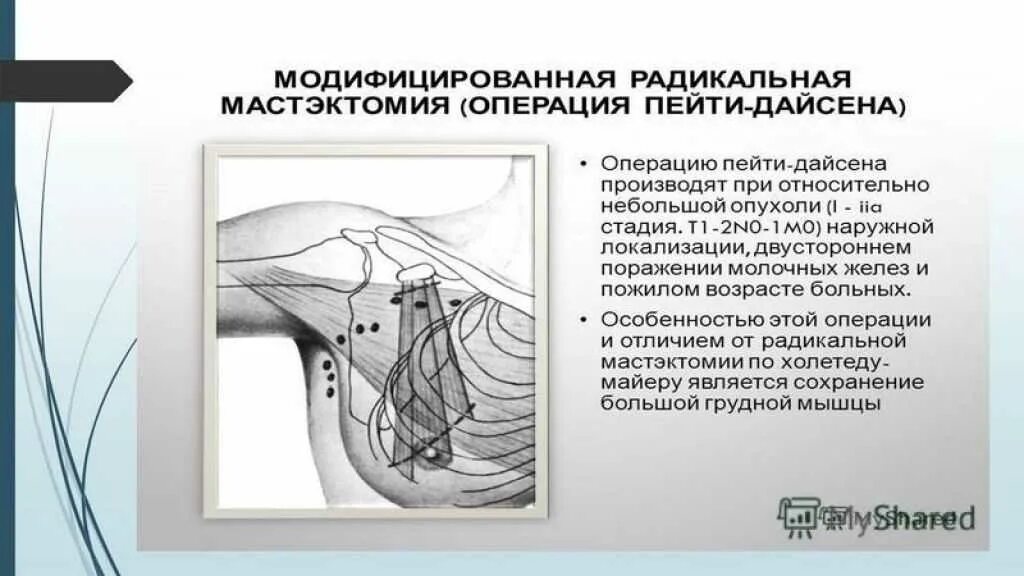 После операции молочной железы и лимфоузлов. Радикальная мастэктомия по Холстеду Майеру. Операция радикальная резекция молочной железы. Радикальная мастэктомия по Холстеду разрез. Секторная резекция молочной железы.