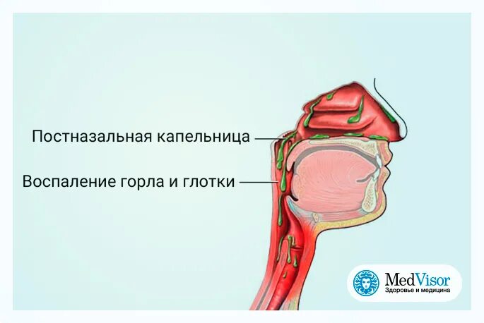 Постназальный синдром. Синдром постназальногозатекания. Синдром назального затекания. Постназальный затек и кашель.