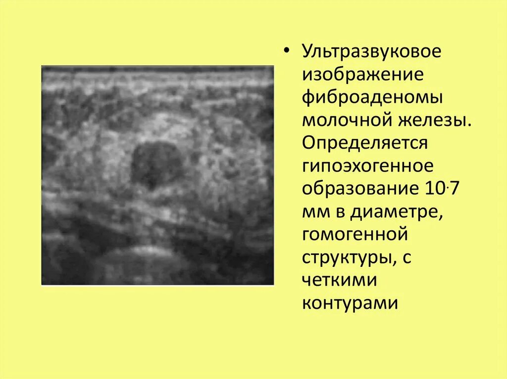 Гипоэхогенное округлое образование. Гипоэхогенные образования в молочной железе. Гипоэхогенное образование в груди. Фиброаденомы молочной железы гипоэхогенное образование. Гипоэхогенное образование с нечеткими контурами в молочной железе.