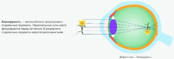 Физиологическая оптика. Нарушение зрения схема. Ход лучей при близорукости. Дефекты зрения симптомы. Интеллект карта "дефекты зрения".