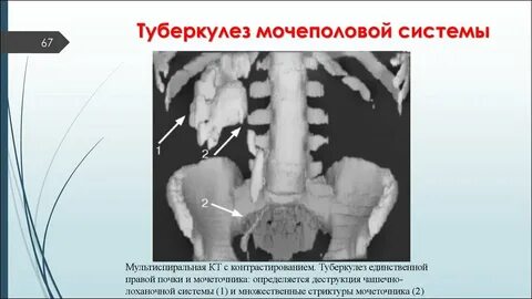 Мочевой туберкулез