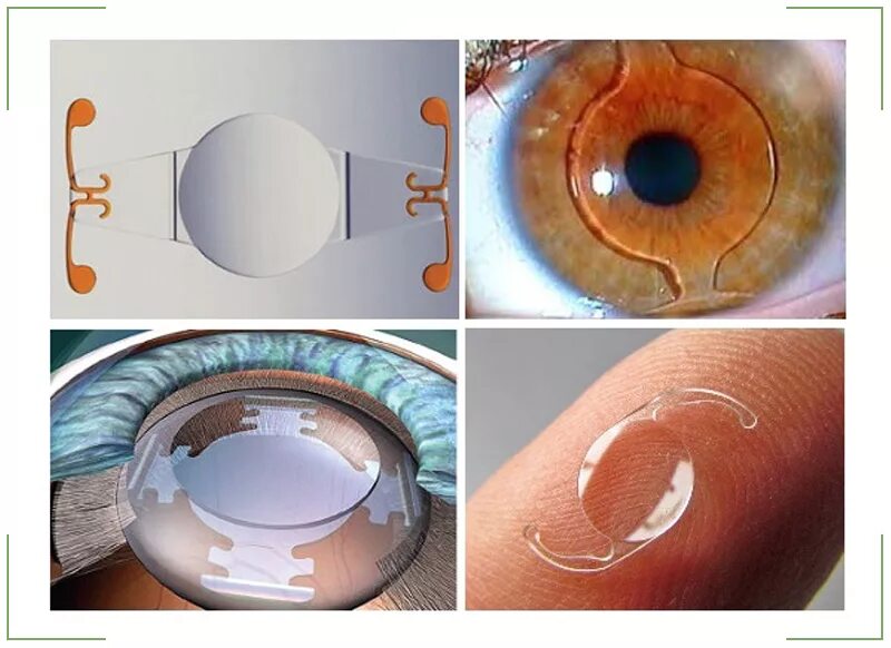 Что нельзя делать при замене хрусталика глаза. ИОЛ ACRYSOF sn60wf IQ. Спицевидная катаракта. Линза интраокулярная ACRYSOF. Имплантация факичных ИОЛ.