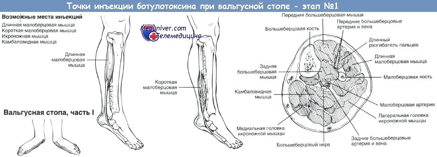 Электростимуляция мышц при вальгусных стопах ног у детей. Схема типирование вальгусной косточки. Расположение электродов при плоско-вальгусных. При плоско-вальгусной стопе наружная головка икроножной мышцы. Точка уколова