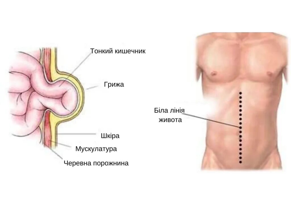 Что можно после грыжи. Грыжи пупочные и белой линии живота. Грыжа белой линии живота классификация. Эпигастральная вентральная грыжа. Послеоперационная грыжа белой линии живота.