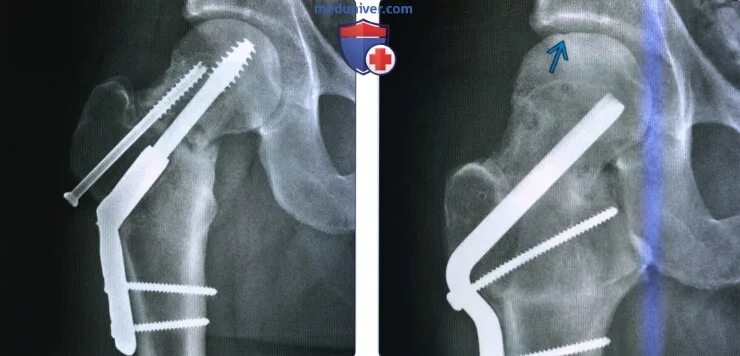 Перелом бедра восстановление после операции. Базисцервикальный перелом шейки бедра рентген. Перелом шейки бедра остеосинтез рентген. Перелом шейки бедра рентгенограмма. Остеосинтез тазобедренного сустава рентген.