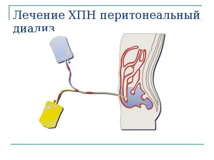 Брюшной диализ