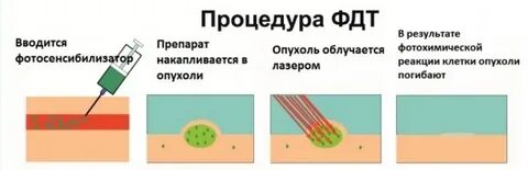 Фотодинамическая терапия отзывы