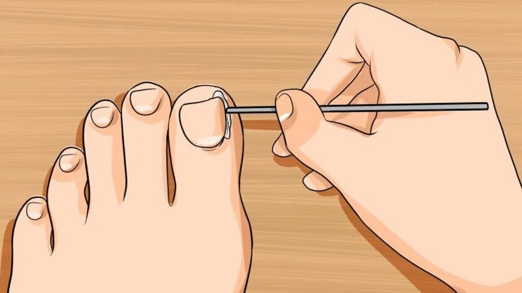 Правильная стрижка ногтей на ногах. Правильное подстригание ногтей на ногах. Как правильно подстригать ногти на ногах. Можно ногти обрезать