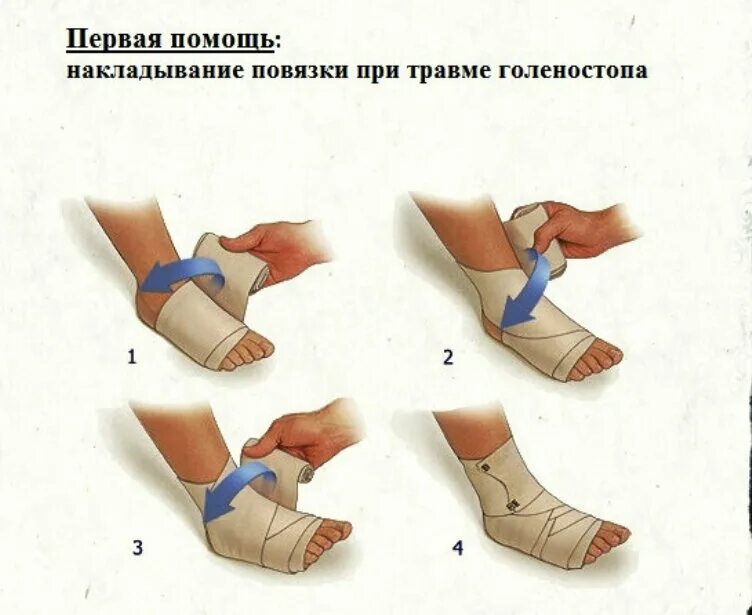 Первая помощь при растяжении связок. Иммобилизация голеностопа при растяжении связок. ПМП при переломе голеностопного сустава. Оказание первой помощи при повреждении голеностопного сустава. Оказание первой помощи при вывихе голеностопа.